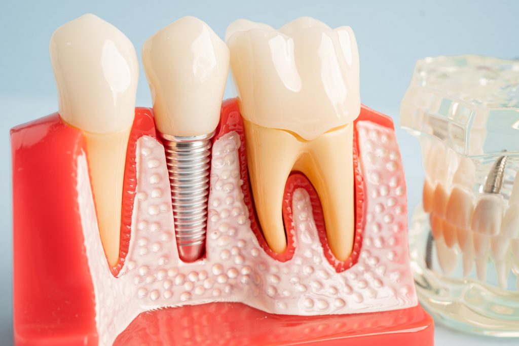 Model showing dental implants which are one of the options for missing teeth